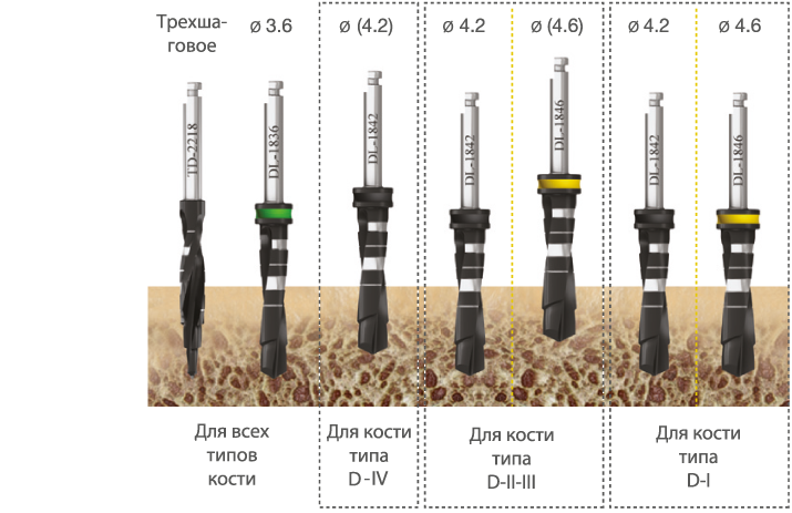 implantat_one