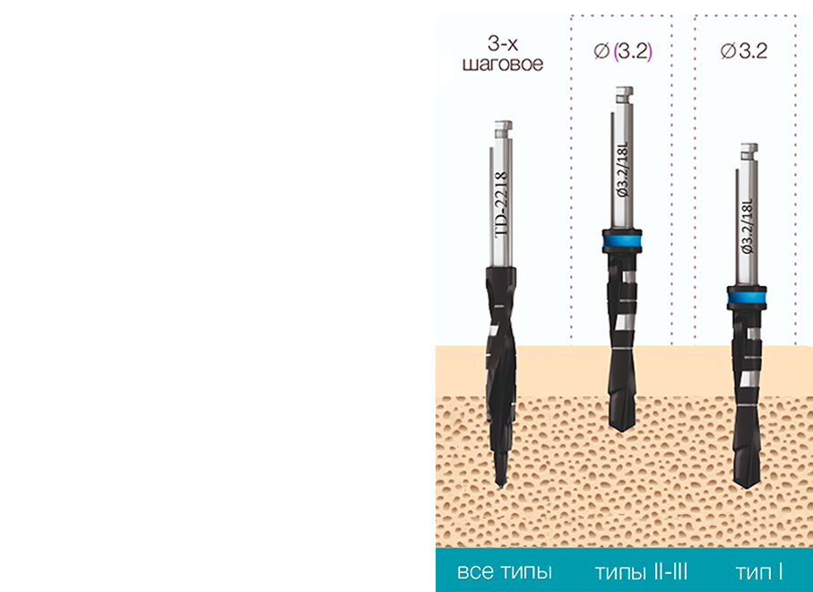 implantat_touareg_s