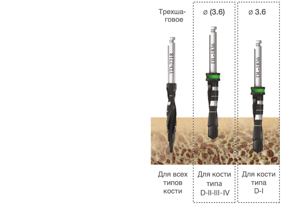 implantat_touareg_s