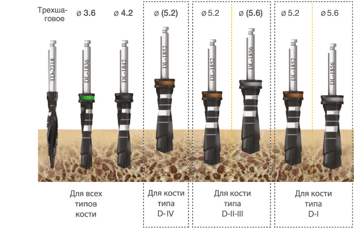 implantat_touareg_s